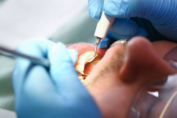 Best Emergency Dentist for Lost Fillings or Crowns in Mclean, VA